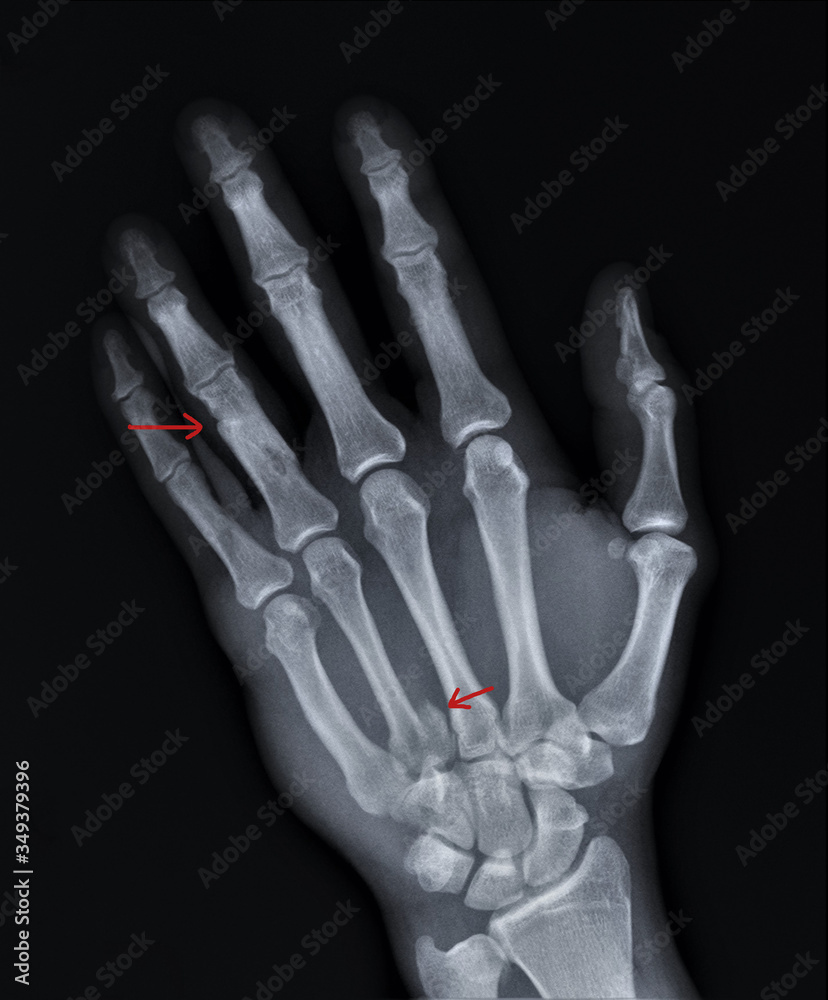 x-ray of the hand with fused bone fractures x-ray of the hand with fused bone fractures