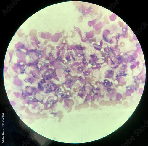 Yeast cells phagocytosis by white blood cell in blood smear.