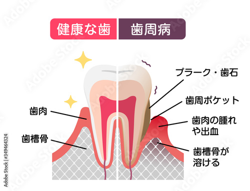 Comparison of normal teeth and periodontal disease. flat vector illustration