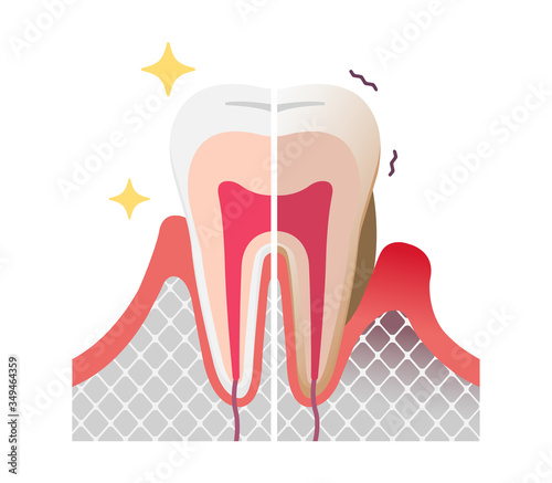 Comparison of normal teeth and periodontal disease. flat vector illustration