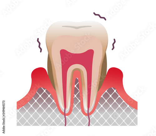 periodontal disease tooth and gum flat vector illustration