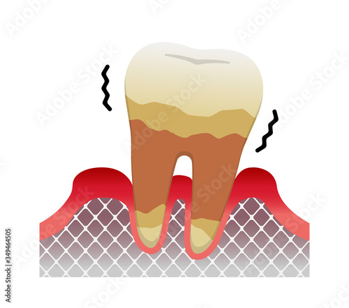 The stages of periodontitis disease   / Severe periodontitis