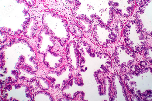 Tableau sur toile Prostate cancer, light micrograph