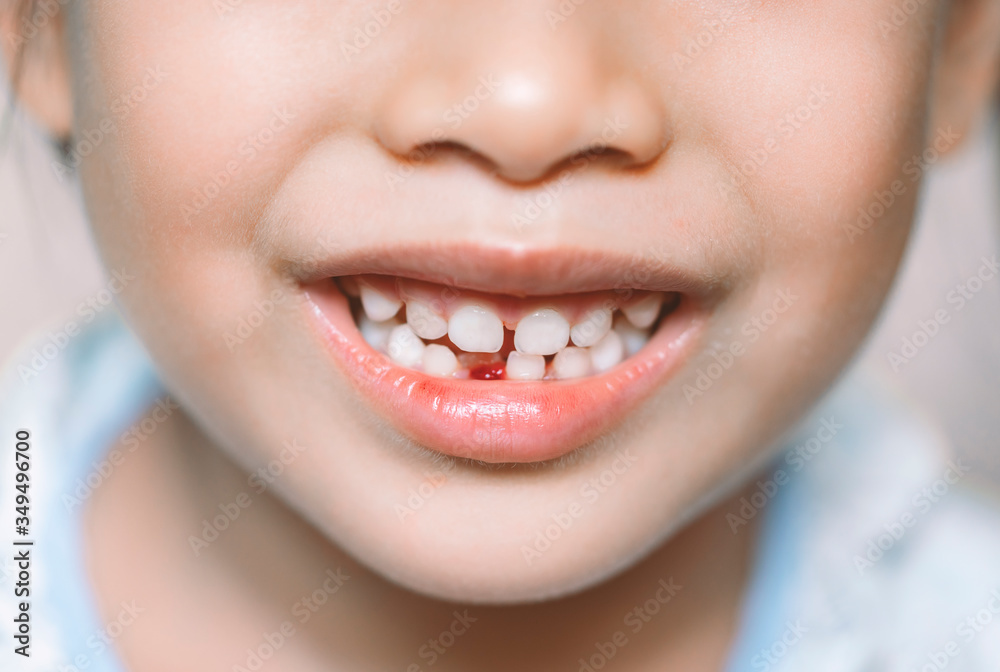 milk teeth that just fell out Stock Photo | Adobe Stock