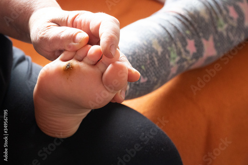 A case of a plantar wart (verruca plantaris) in a young male. photo