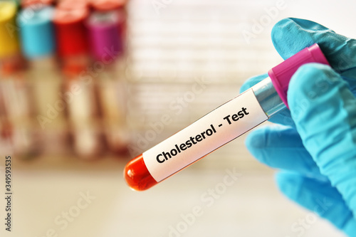 Test tube with blood sample for cholesterol test photo