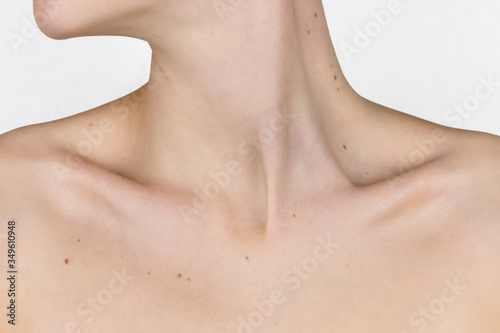 necklace of moles, moles on the neck, collarbone and breast of a young girl, concept of skin care, beauty and risks of papillomavirus cancer photo