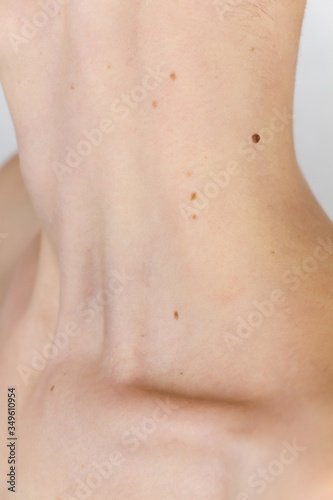 neck and collarbone of a young girl with a lot of moles, concept of skin care, beauty and cancer risks due to papillomavirus