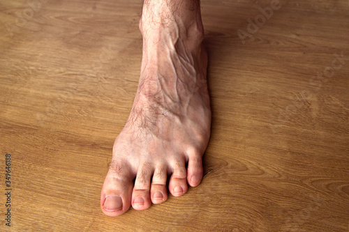 a man foot with a mesh of dilated varicose veins stands on a blue background © Yekatseryna