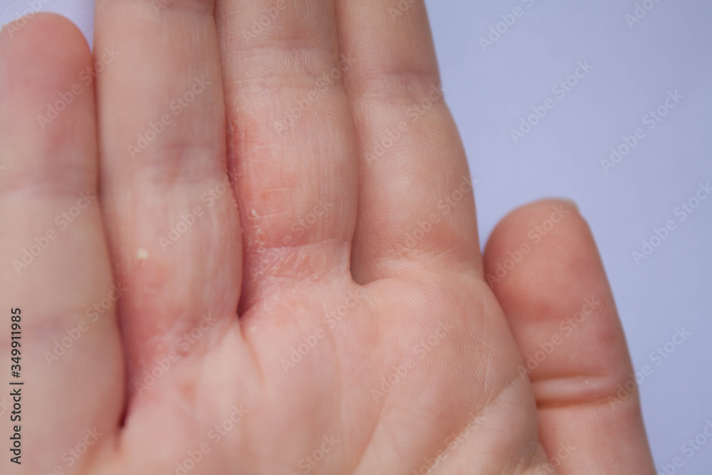 Mano de paciente con dermatitis atópica interdigital en la consulta de dermatología Mano de paciente con dermatitis atópica interdigital en la consulta de dermatología
