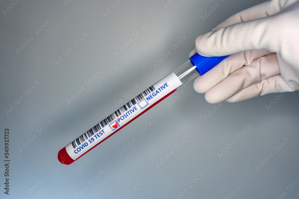 Obraz premium Blurry image of a hand while holding a test tube containing a patient’s sample that has tested positive for coronavirus (COVID-19).