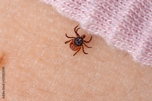 Infected tick on human skin. Carrier of infections of encephalitis disease and Lyme borreliosis. Parasite mite on person crawling under clothes. Ixodes ricinus. Dangerous biting insect © Komarov Dmitriy