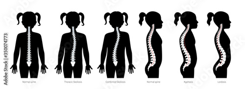 Girl spinal deformity flat vector illustration