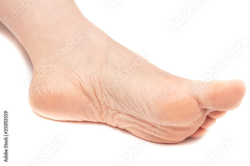 Dry and cracked soles of feet on white background