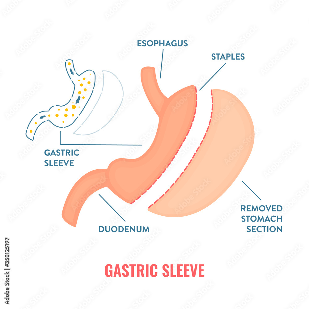 Vertical sleeve gastrectomy. Bariatric surgery weight loss procedure