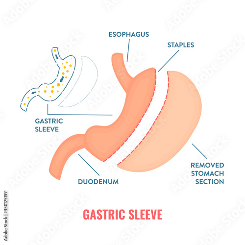 Vertical sleeve gastrectomy. Bariatric surgery weight loss procedure. Stomach reduction anatomical diagram infographic. Health care  medical concept. Vector illustration.