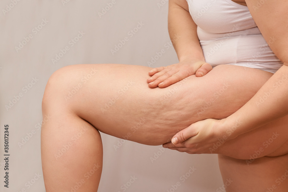Cellulite leg woman pinch. Test fat hips treatment. Over weight liposuction.  Remove striae. Stock Photo | Adobe Stock