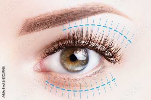 Blepharoplasty treatment, plastic surgery, face lift concept. Female eye close up photo