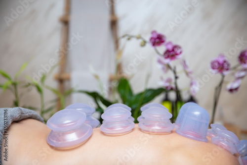Cups applied to back skin of a female patient as part of the traditional method of cupping therapy