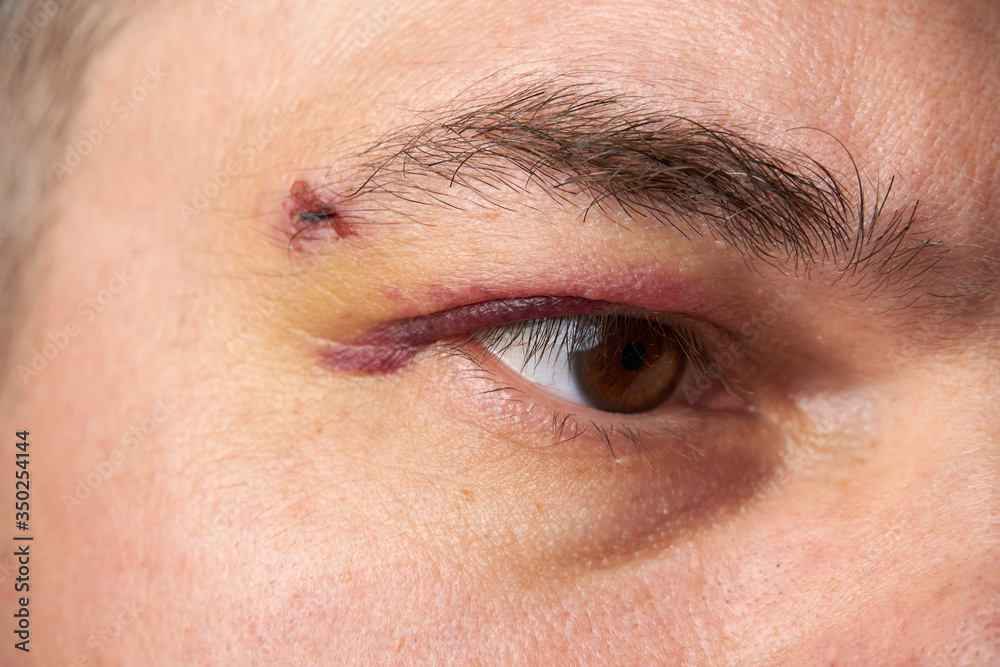Fototapeta premium close view of a bruise near the eye, the face of a man with a hematoma