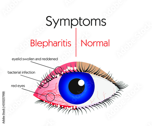 human eyes, blepharitis, symptoms, infographics eye disease pattern, Health care and medical infographics, bacterial infection, vector illustration for educational and medical institutions, stock photo