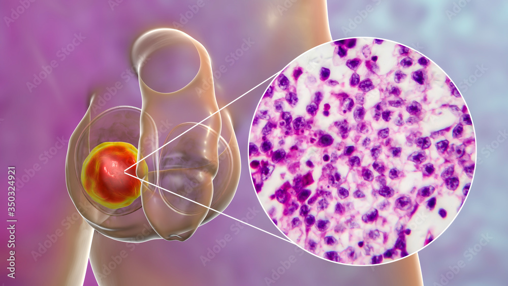 Testicular seminoma, germ cell tumor of the testis Testicular seminoma, germ cell tumor of the testis