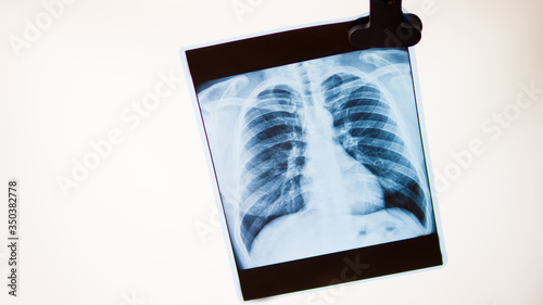 Chest X-rays on negatoscope. Negatoscope isolated on white background. photo