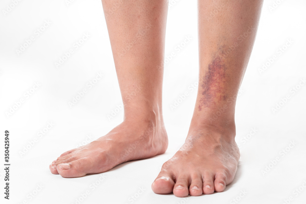 Asian women have bruise on leg from accident on white background. Asian women have bruise on leg from accident on white background.