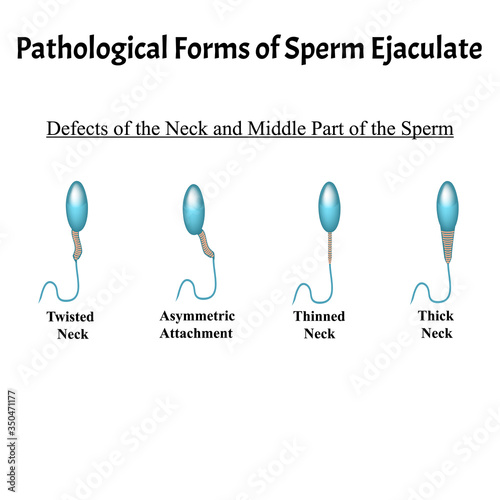 Pathological forms of sperm in the ejaculate. Male infertility Oligospermia. Spermogram. Pathology of the head. Sperm defects. Infographics. Vector illustration on isolated background.