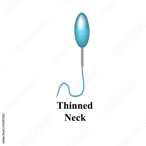 Pathological forms of sperm in the ejaculate. Male infertility Oligospermia. Spermogram. Sperm defects. Infographics. Vector illustration on isolated background.