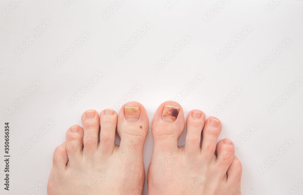 Injury to the nail due to wearing uncomfortable shoes.Treatment of hematoma of toenail.Medicine concept.shoe nail injury Injury to the nail due to wearing uncomfortable shoes.Treatment of hematoma of toenail.Medicine concept.shoe nail injury