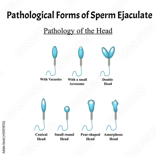 Pathological forms of sperm in the ejaculate. Male infertility Oligospermia. Spermogram. Pathology of the head. Sperm defects. Infographics. Vector illustration on isolated background.