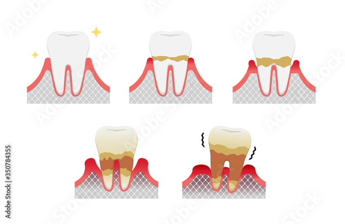 The stages of periodontitis disease vector illustration