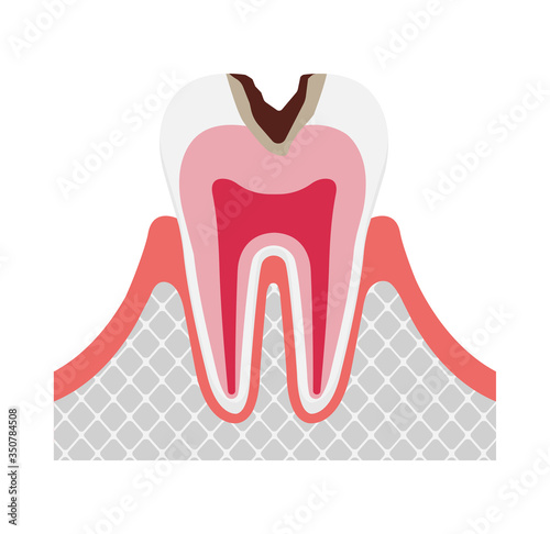 The stage of tooth decay / Decay in dentin