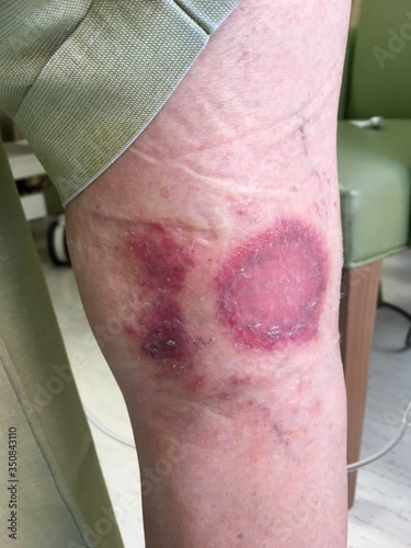 Skin lesions on leg
Symptoms that are common in the elderly Which starts with a red rash in a small circle And expanding to a wider area