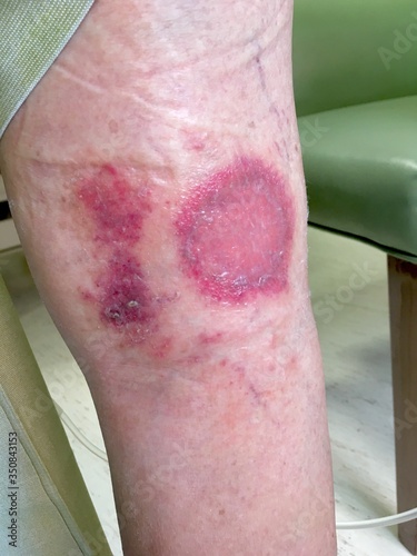 Skin lesions on leg
Symptoms that are common in the elderly Which starts with a red rash in a small circle And expanding to a wider area