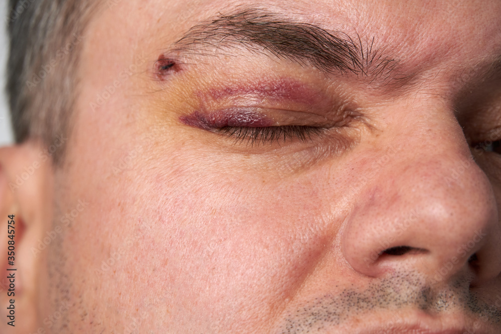close view of a bruise near the eye, the face of a man with a hematoma close view of a bruise near the eye, the face of a man with a hematoma
