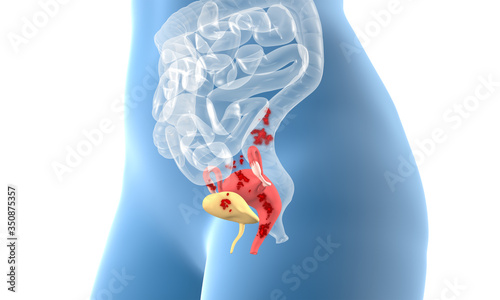 Endometriosis, female disease, 3D educational, medical illustration on white background photo