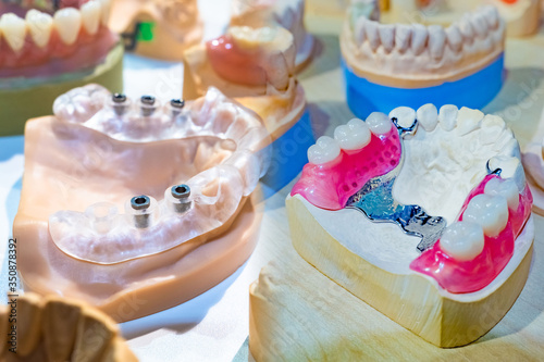 Denture. Elimination of various dental problems. The assistance of a dentist. The prosthetist makes dental bridges and veneers. Dental clinic. photo