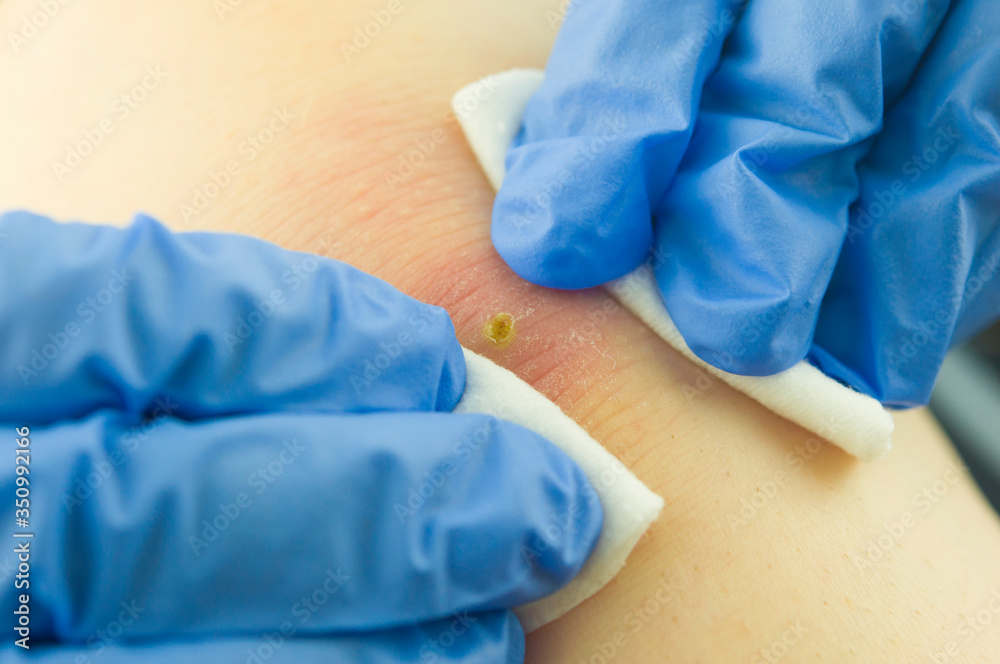 the doctor opens a purulent pimple the doctor opens a purulent pimple