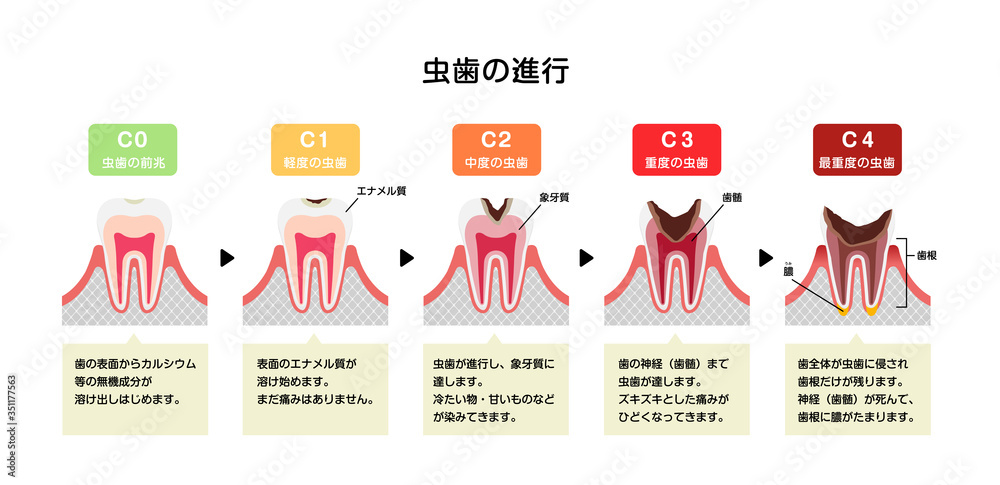 虫歯の進行と症状 イラスト Stock Vector Adobe Stock