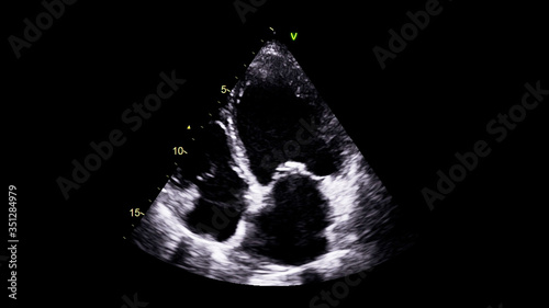 Image of the heart in gray-scale mode during transesophageal ultrasound.