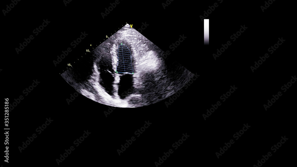 Image of the heart in gray-scale mode during transesophageal ultrasound. Image of the heart in gray-scale mode during transesophageal ultrasound.