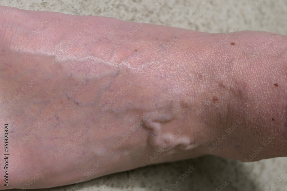 Clearly visible veins and protruding varicose veins on one foot Clearly visible veins and protruding varicose veins on one foot