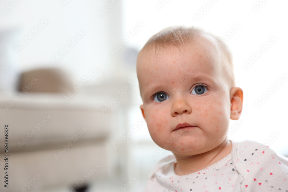 Little child with red rash indoors, space for text. Baby allergies