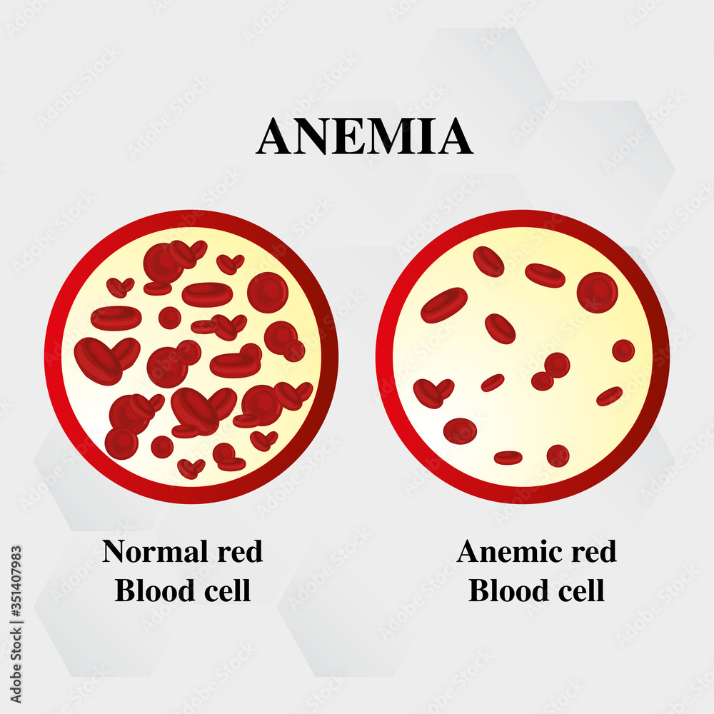 world hemophilia day red blood cell Iron deficiency anemia difference