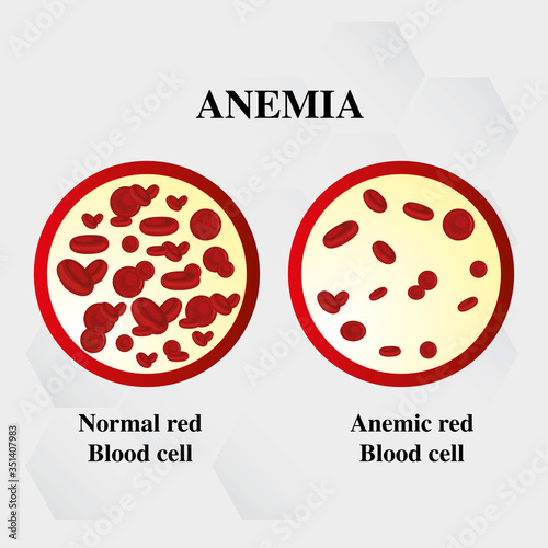 world hemophilia day red blood cell Iron deficiency anemia difference of Anemia amount of and normal symptoms vector illustration medical.

