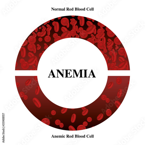 world hemophilia day red blood cell Iron deficiency anemia difference of Anemia amount of and normal symptoms vector illustration medical.
