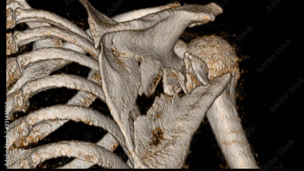 CT Scan shoulder. Fracture posterior half of glenoid with posterior dislocation of bone fragment