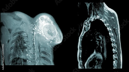 Magnetic resonance (MRI) of Shoulder Joint Impression:The mass Lt.shoulder DDx.soft tissue sarcoma & metastasis.Medical healthcare footage concept.